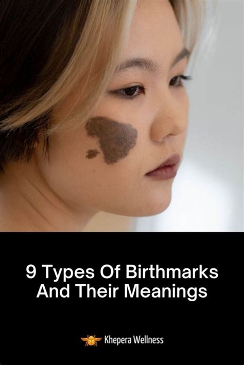 Trying dermatologists have failed to explain why . . Birthmark meaning in islam